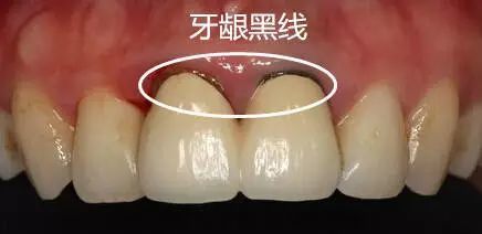 做完烤瓷牙牙龈出血