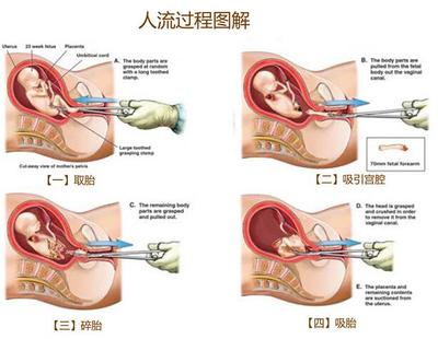 无痛人流后出血量有多少