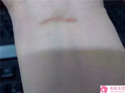 用什么去疤痕比较好