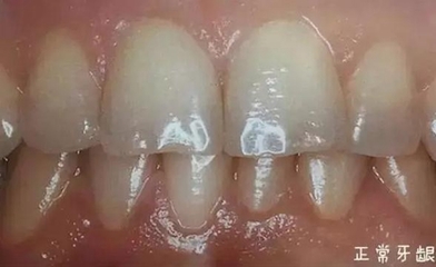 牙周炎早期怎么治疗
