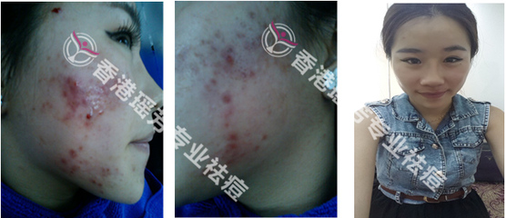 美容院能治疗痘痘吗