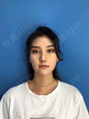 隆鼻7天后拆线疼不疼