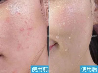 为什么痘坑不长痘痘