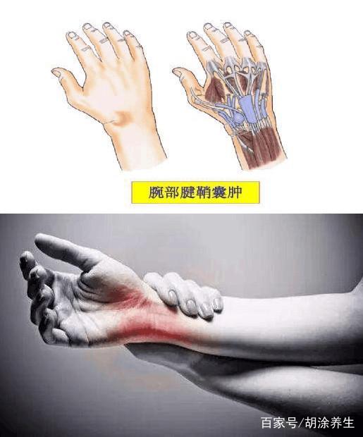腱鞘囊肿是怎么引起的怎么治疗