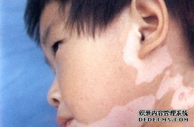 新生儿皮肤多久会变白