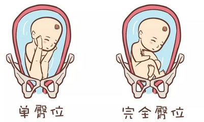 宝宝在肚子里的姿势
