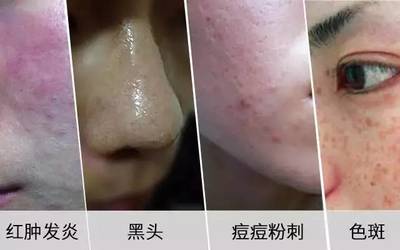 痘痘有周期吗