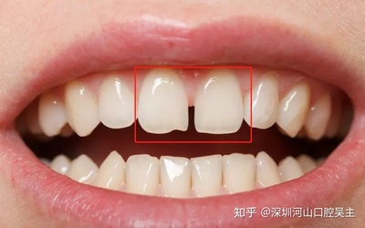 牙缝大怎么治疗