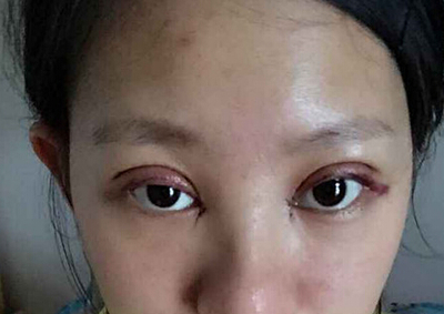 小眼角充血是怎么回事