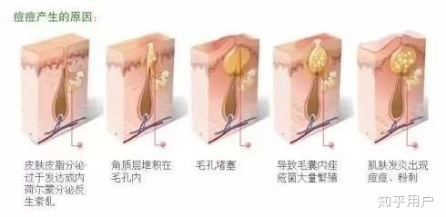 痘痘是疮吗