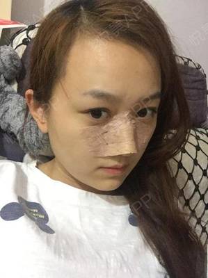 减肥瘦鼻子吗