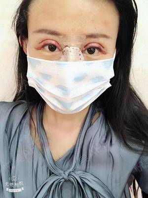 假体隆鼻眼睛周围肿了
