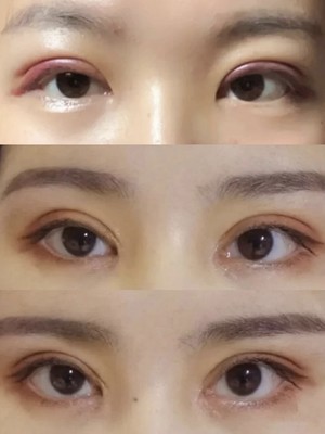 妈妈给的双眼皮多钱