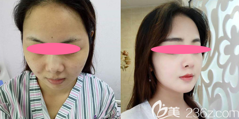隆鼻效果怎么样