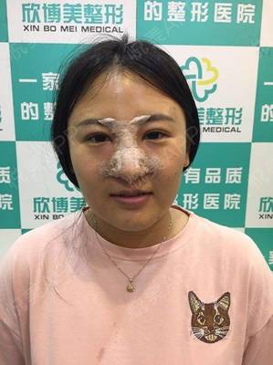 隆鼻可以侧身睡觉吗
