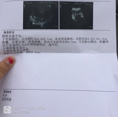 孕酮吃多了对胎儿有影响吗