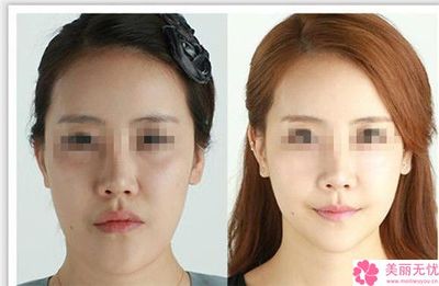 瘦脸针可以打四次吗