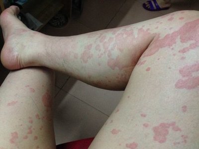 脚上有血斑是怎么回事