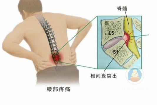 腰椎间盘突出怎么治疗最好