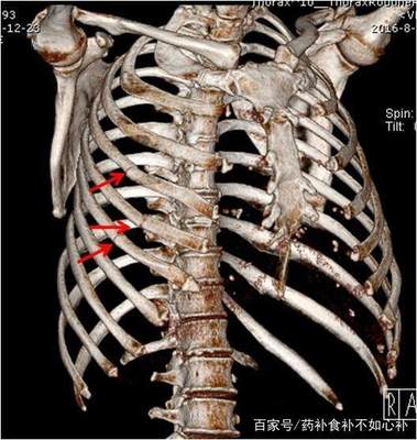 后肋骨疼是怎么回事