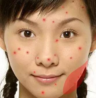 女人痘痘是指哪里