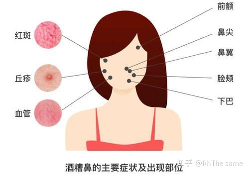 眉间粉刺是什么原因