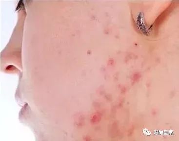 淋巴部位长痘痘怎么治