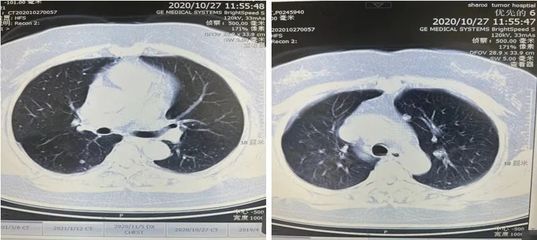 双肺小结节怎么治疗