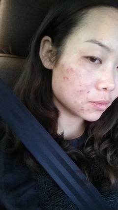 痘痘痘印用什么韩妆