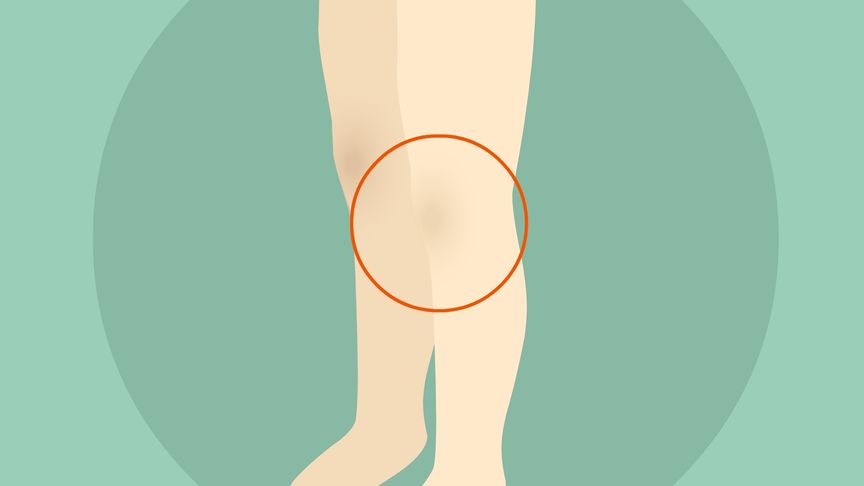 膝关节困疼是怎么回事