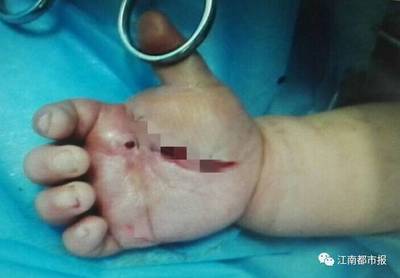 伤口发黑是怎么回事