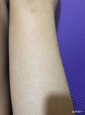 皮肤鱼鳞病怎么治疗