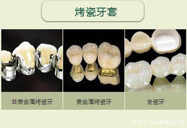 带牙套好还是烤瓷牙好