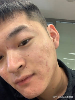 碘伏痘痘