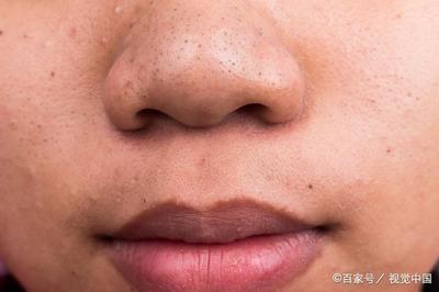 中学生长痘痘