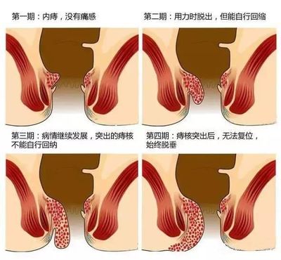 痔疮怎么治疗效果好