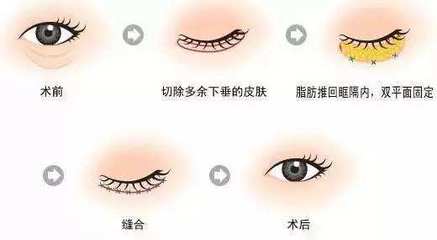 美莱整形去眼袋
