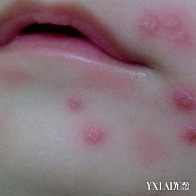 玩电脑长了好多痘痘