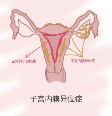 盆腔粘连能怀孕吗