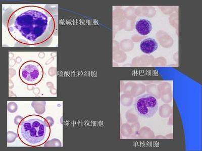 新生儿淋巴细胞绝对值偏高