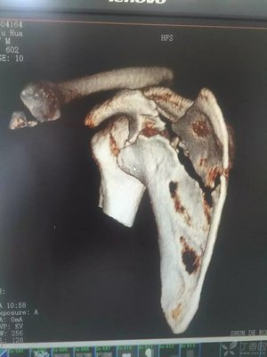 肩胛骨骨折怎么治疗