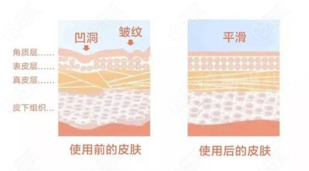 玻尿酸能打哪里