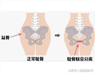 怀孕会屁股疼吗