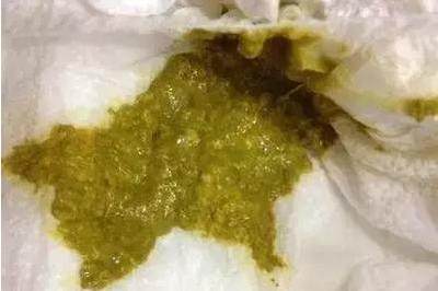 新生儿拉屎有泡沫怎么回事