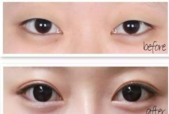 双眼皮修复失败