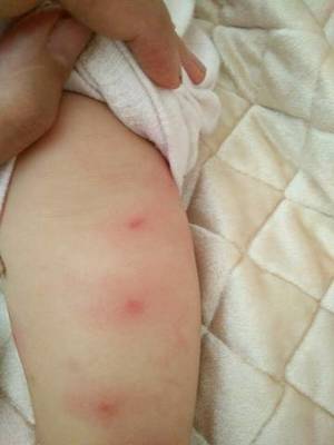 宝宝身上起红点点