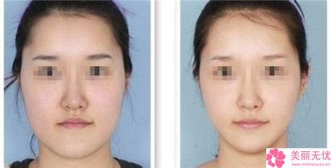 保妥适除皱效果怎样