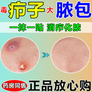 粉瘤和痘痘的区别