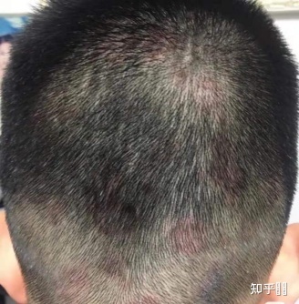头皮里有小痘痘怎么回事