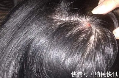 头发出油长痘痘痛怎么办